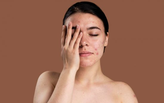 Una chica con la cara llena de manchas y granitos / P Una chica con la cara llena de manchas y granitos / P
