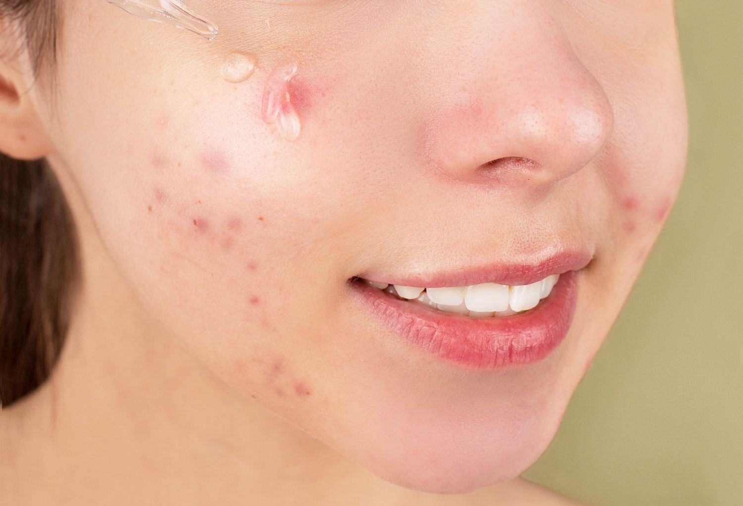 Le aplican una solución para la piel a una chica joven / PEXELS