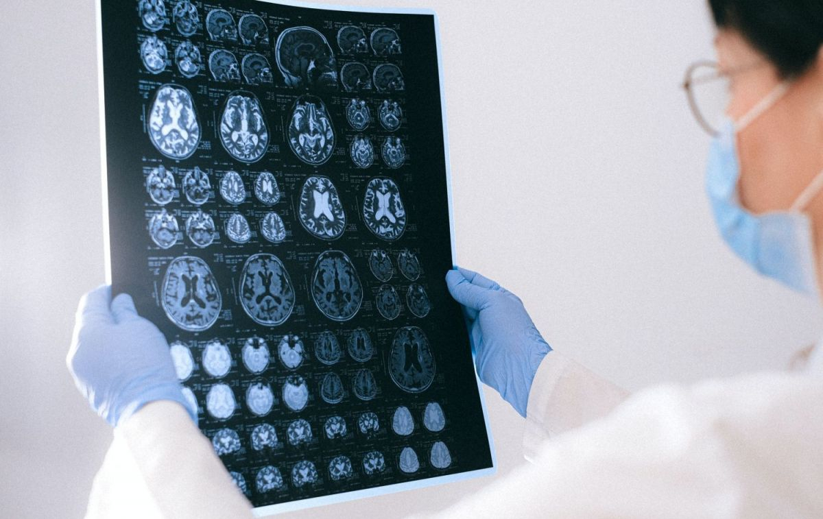 Resonancia magnética del cerebro de un paciente con Alzheimer / PEXELS