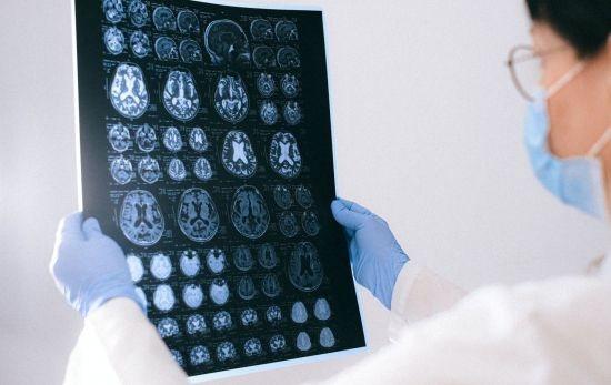 Resonancia magnética del cerebro de un paciente con Alzheimer / PEXELS Resonancia magnética del cerebro de un paciente con Alzheimer / PEXELS
