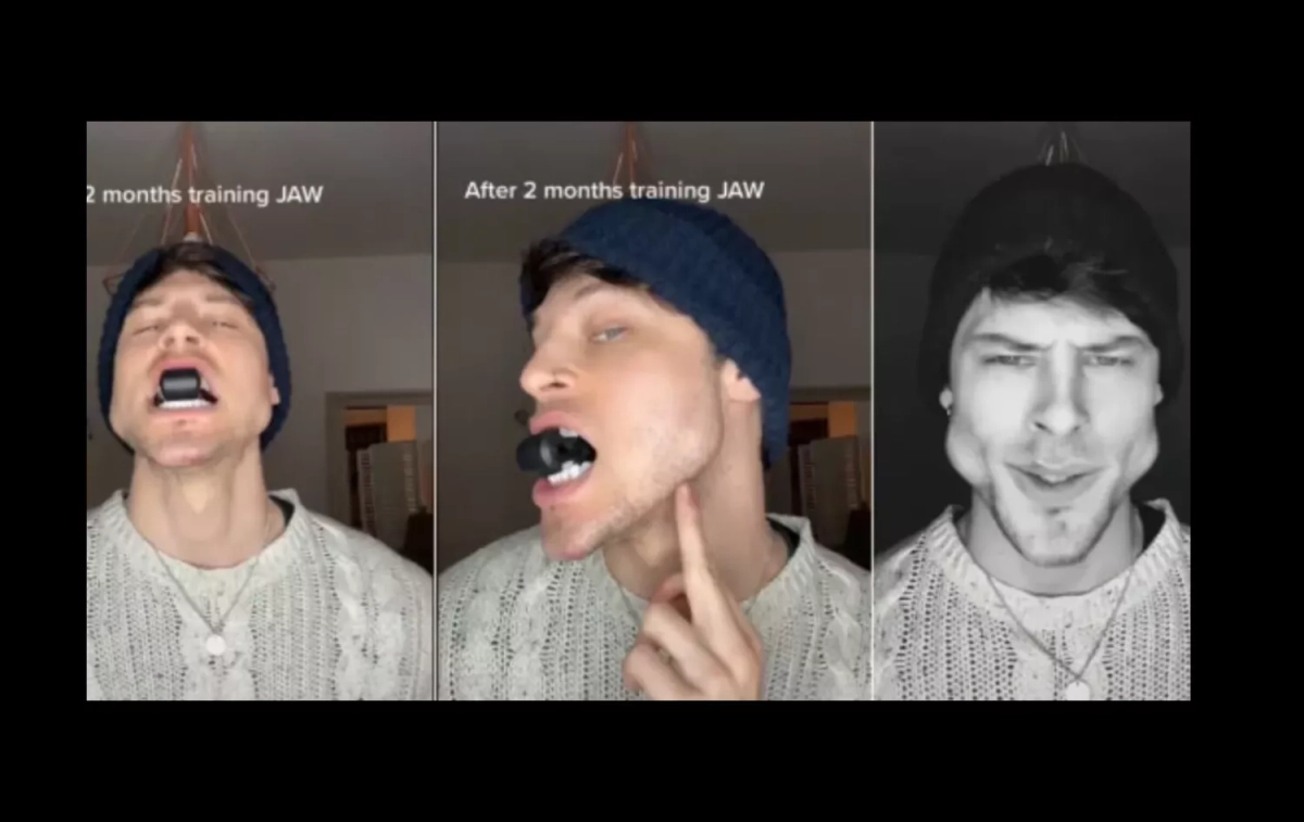 el uso de ejercitadores de mandíbula como el Jawliner, popularizado por el modelo italiano Luca Mar el uso de ejercitadores de mandíbula como el Jawliner, popularizado por el modelo italiano Luca Mar