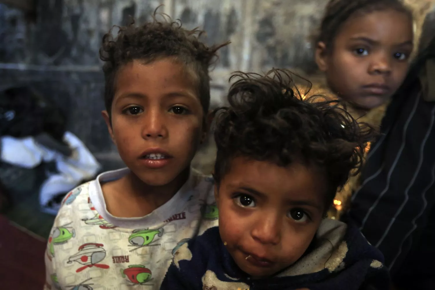 Niños que sufren malnutrición en Yemen, una tragedia que se puede prevenir / Osamah Yahya - EP