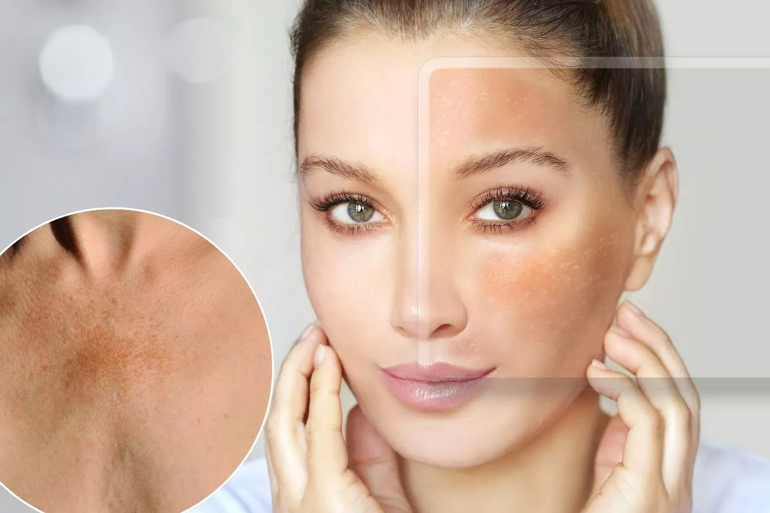 Una chica con manchas solares en el rostro este verano / Montaje CONSUMIDOR GLOBAL Una chica con manchas solares en el rostro este verano / Montaje CONSUMIDOR GLOBAL