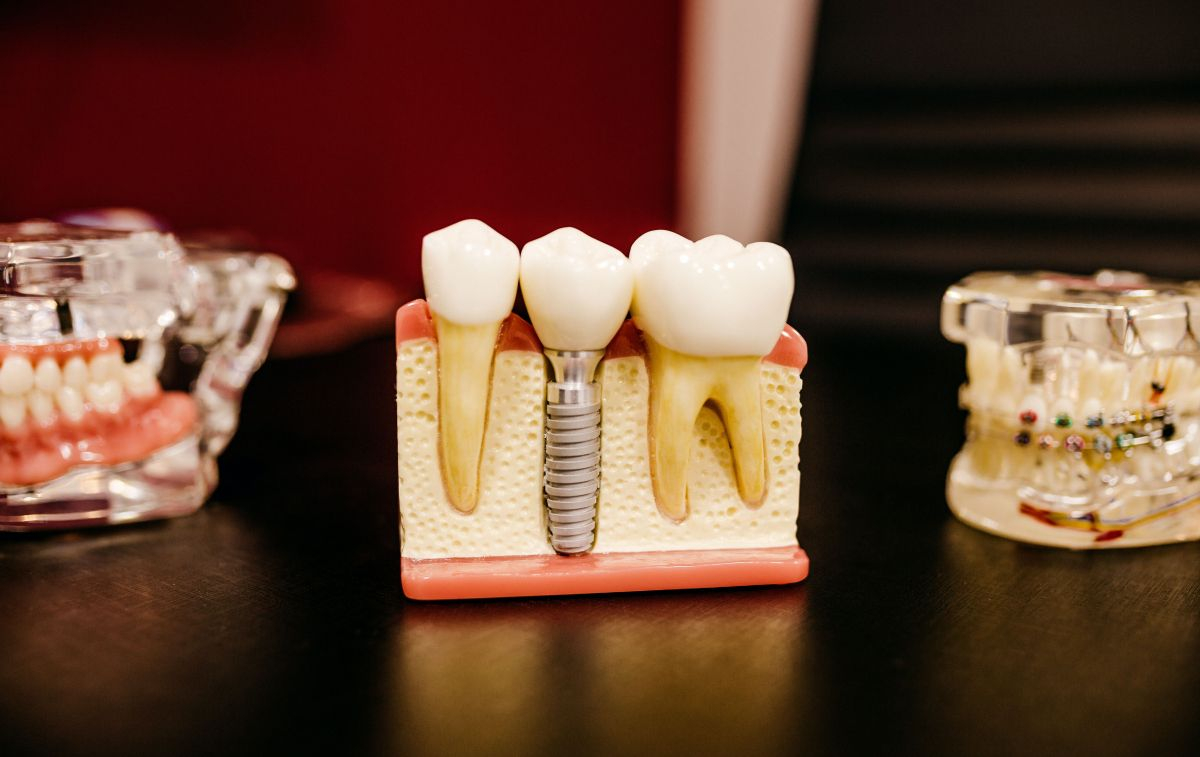 Prótesis de dientes blanqueados / UNSPLASH