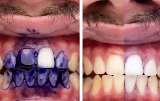 Cómo actúan este tipo de blanqueadores dentales / OBSESSIVE Cómo actúan este tipo de blanqueadores dentales / OBSESSIVE